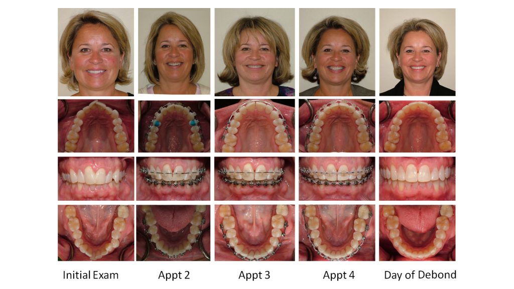 قبل و بعد ارتودنسی