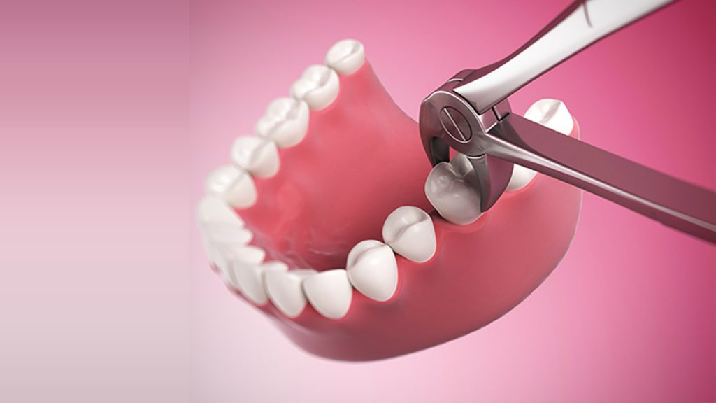 کشیدن دندان، بخشی از درمان ارتودنسی