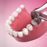 کشیدن دندان، بخشی از درمان ارتودنسی