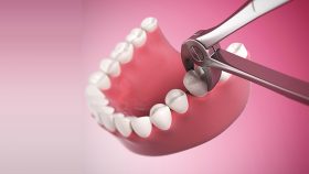 کشیدن دندان، بخشی از درمان ارتودنسی