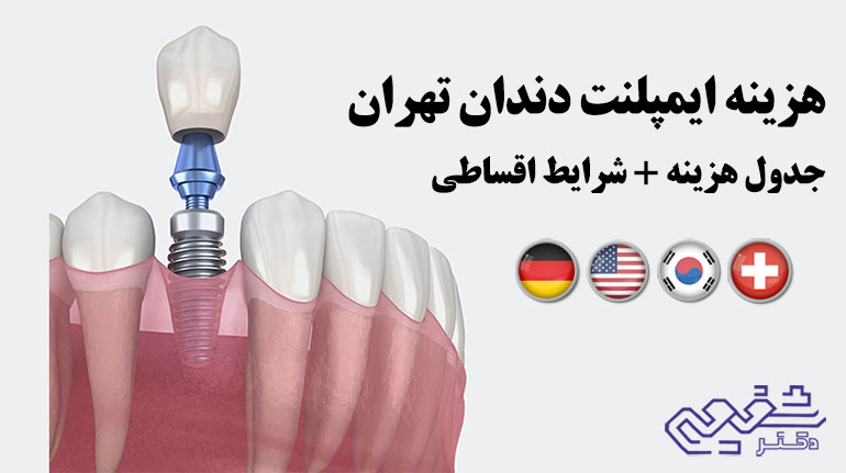 هزینه ایمپلنت دندان در تهران