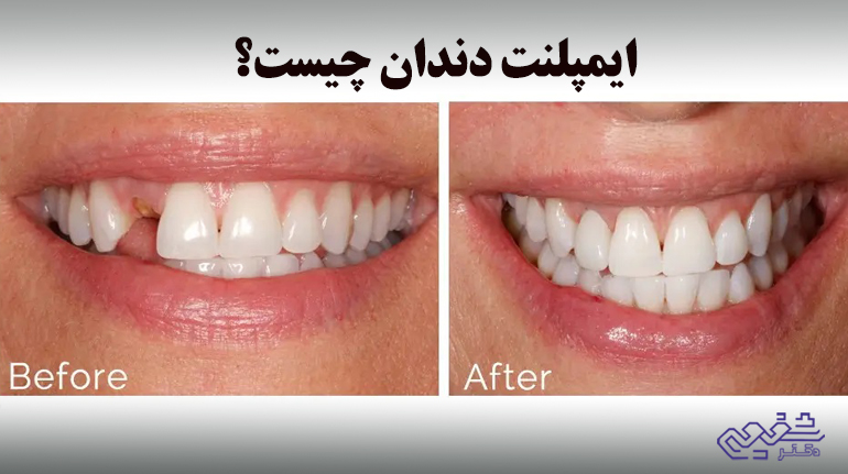 ایمپلنت دندان چیست؟