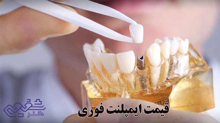 قیمت ایمپلنت فوری