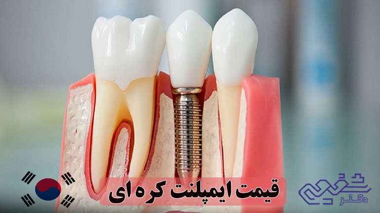 قیمت ایمپلنت کره ای