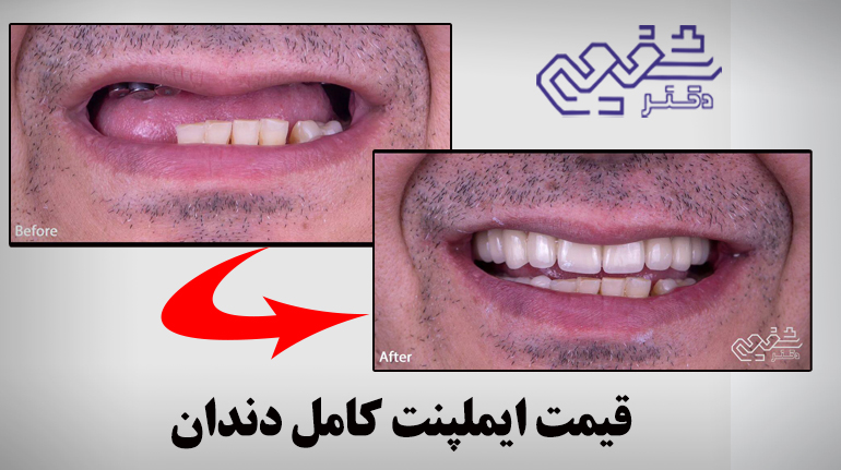 قیمت ایمپلنت کامل دندان