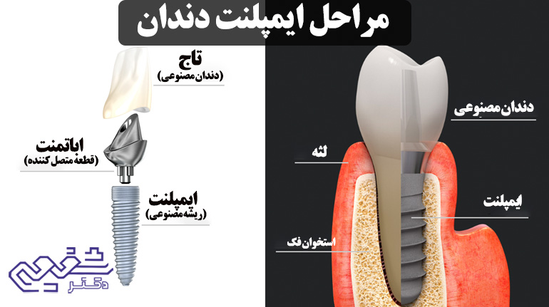 مراحل ایمپلنت دندان