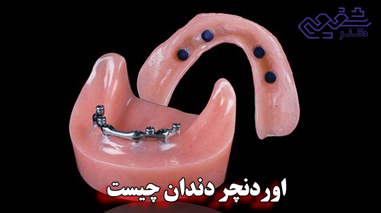 دندان اوردنچر