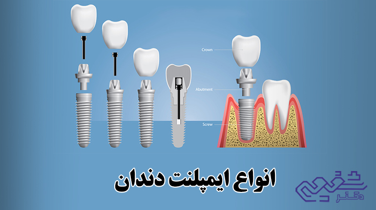 انواع ایمپلنت دندان