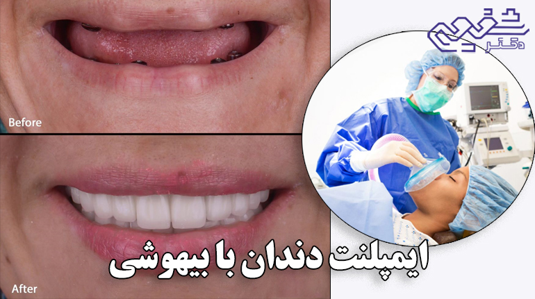 ایمپلنت دندان با بیهوشی