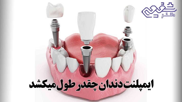ایمپلنت دندان چقدر طول میکشد